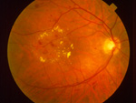 Diabetische Retinopathie